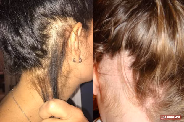  Khi nhổ tóc người bệnh có cảm giác khoan khoái giống như sử chất kích thích. Ảnh minh họa 