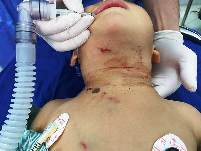 Bé trai 3 tuổi bị chó hàng xóm cắn thủng khí quản ảnh 2 Bé trai 3 tuổi bị chó hàng xóm cắn thủng khí quản - ảnh 1