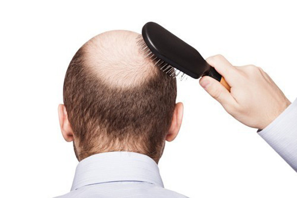 Bỏ 200 triệu đi cấy tóc chữa hói, quý ông Hà Nội nhận cái kết không thể đắng hơn