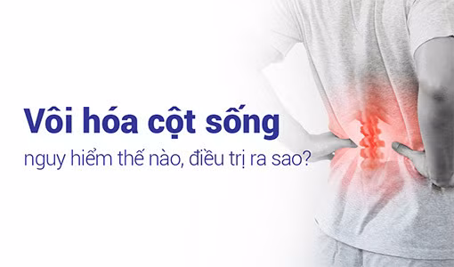 Vôi hóa cột sống gây biến chứng nguy hiểm nếu không được điều trị