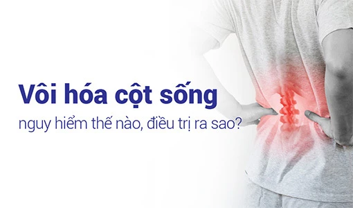 Vôi hóa cột sống gây biến chứng nguy hiểm nếu không được điều trị