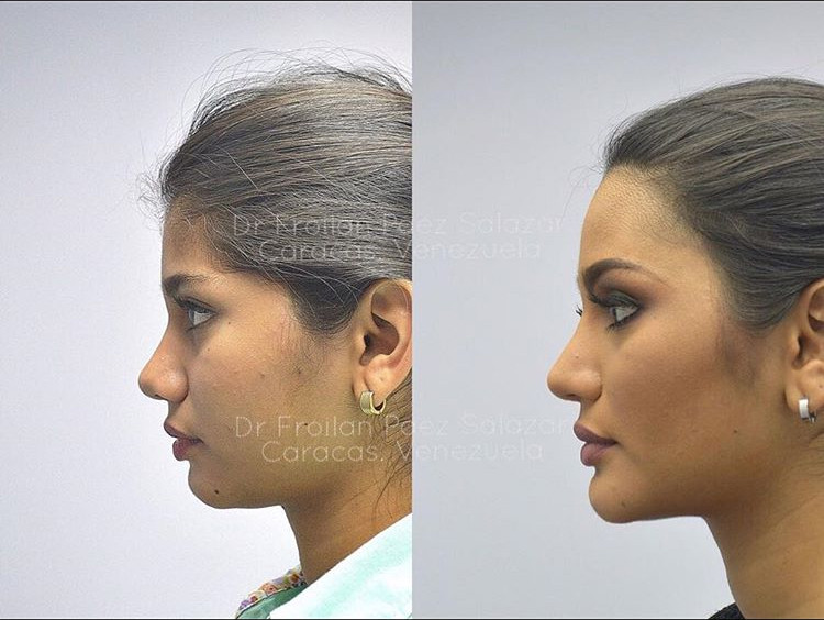 Giật mình với nhan sắc đập đi xây lại của những hoa hậu Venezuela nổi tiếng nhất thế giới-5