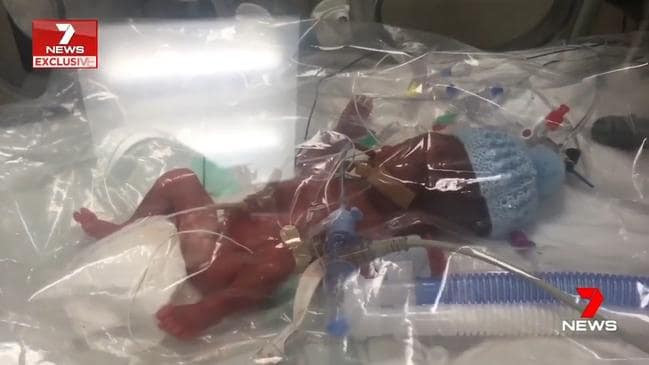 Lạ lùng bé sinh non nhỏ tới mức phải được nuôi trong... túi nhựa để có thể sống sót - Ảnh 1. Lạ lùng bé sinh non nhỏ tới mức phải được nuôi trong... túi nhựa để có thể sống sót - Ảnh 1.