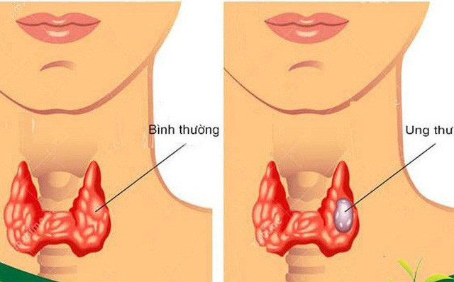 Nuốt nước bọt mà có dấu hiệu này, có khả năng bị ung thư tuyến giáp