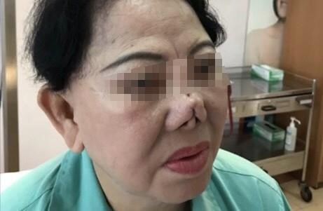 Biến chứng sau nâng mũi, người phụ nữ bỗng chốc biến thành... "quỷ Dạ Xoa" ảnh 1  Chiếc mũi của bà Hòa bị biến dạng sau khi làm đẹp. Ảnh: HL.
