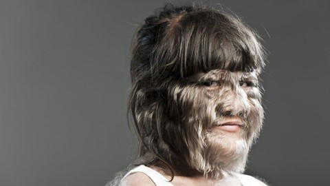 Căn bệnh "người sói" kỳ lạ, Việt Nam chỉ có 3 người mắc ảnh 1  Hypertrichosis khiến người bệnh mọc lông rậm khắp cơ thể và ngứa ngáy, đau rát. Ảnh: Twitter.