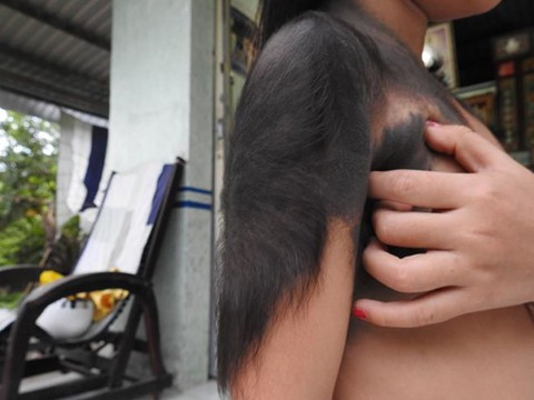 Căn bệnh "người sói" kỳ lạ, Việt Nam chỉ có 3 người mắc ảnh 2  Từ một vết bớt nhỏ trên mặt, lông lan rộng ra khắp cơ thể cháu Bích. Ảnh: Thanhnien.