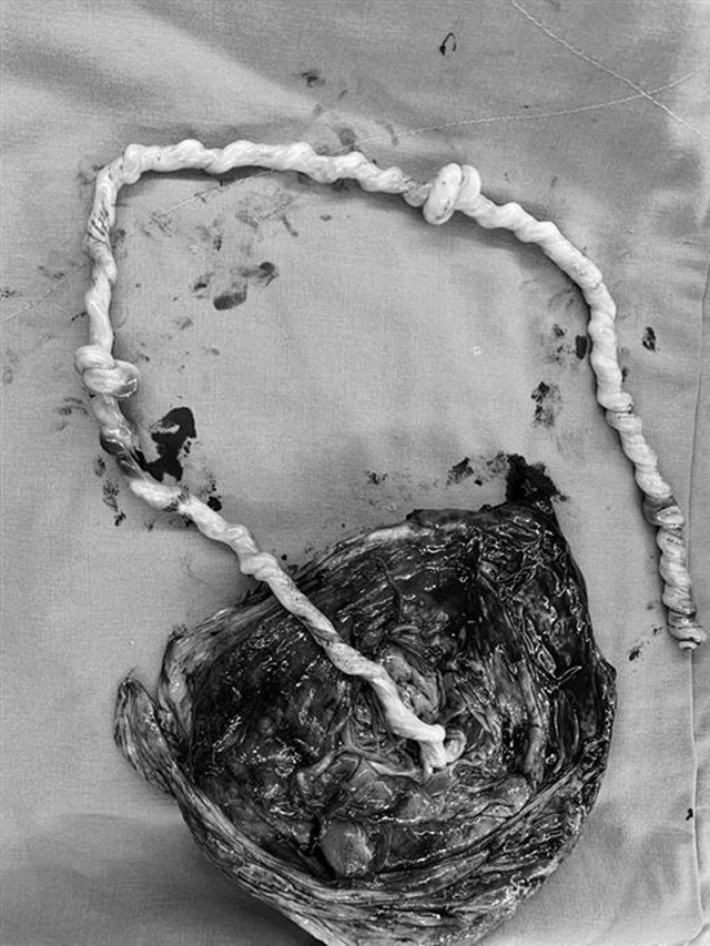 Bác sĩ gọi đây là kỳ tích bởi thai nhi sống sót khi dây rốn thắt nút 2 vòng - Ảnh 1. Bác sĩ gọi đây là kỳ tích bởi thai nhi sống sót khi dây rốn thắt nút 2 vòng - Ảnh 1.