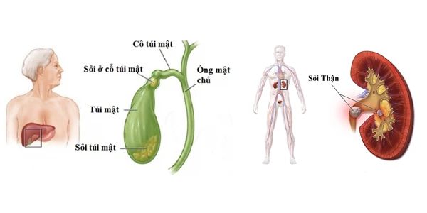 Các vị trí sỏi hình thành tại gan - mật - thận.