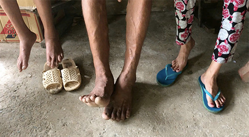 Đôi chân to lớncủa ông Y gần như không có dép giày nào đi vừa. Đôi chân to lớn, của ông Y gần như không có dép giày nào ở địa phương bán mà ông mang vừa. Ảnh: Cửu Long