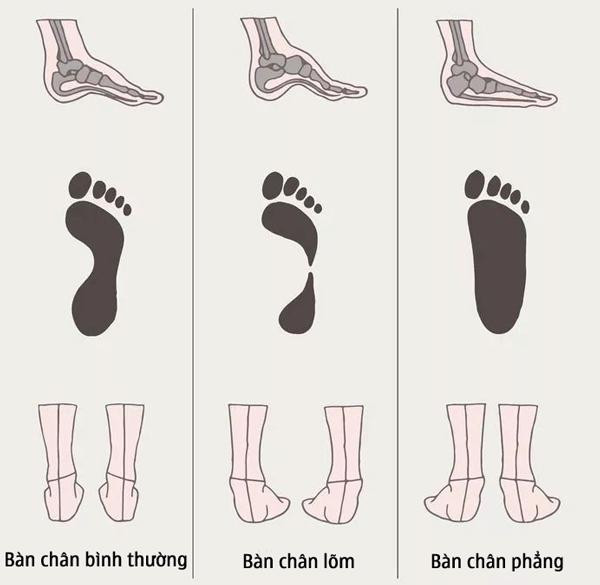 Thường đeo giày cao gót, người phụ nữ mắc bệnh "bàn chân bẹt": kiểm tra ngay trước khi quá muộn! - 4