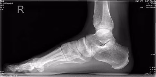 Thường đeo giày cao gót, người phụ nữ mắc bệnh "bàn chân bẹt": kiểm tra ngay trước khi quá muộn! - 2