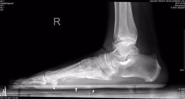 Thường đeo giày cao gót, người phụ nữ mắc bệnh "bàn chân bẹt": kiểm tra ngay trước khi quá muộn! - 3