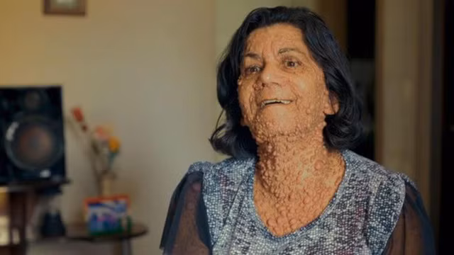 Mỗi phần cơ thể Sandra đều được bao phủ bởi các khối u nhỏ