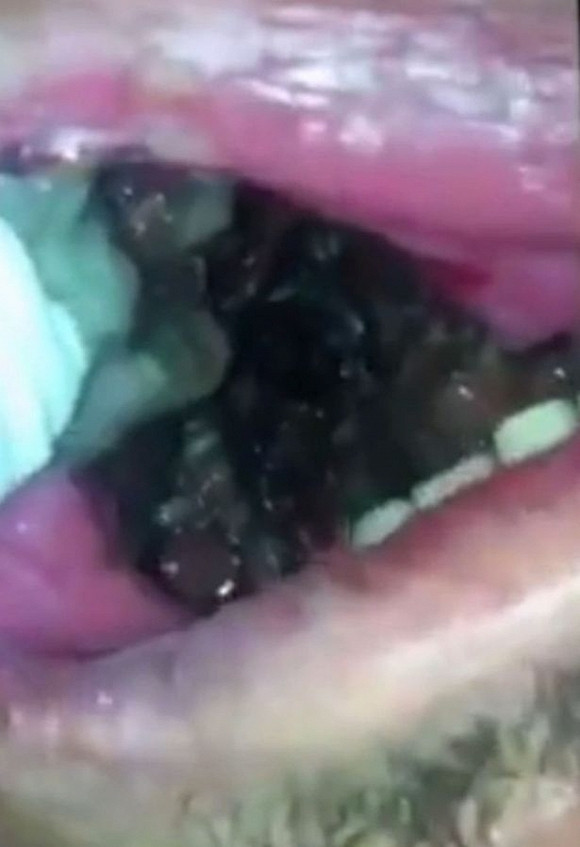 Người đàn ông bị ổ giòi ký sinh trong mệng 0