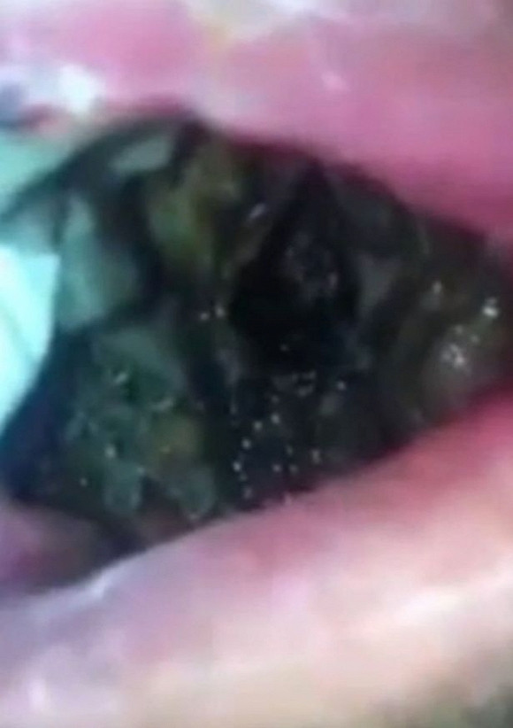 Người đàn ông bị ổ giòi ký sinh trong mệng 1 Người đàn ông bị ổ giòi ký sinh trong mệng 1