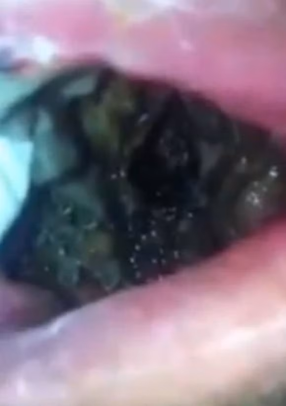 Người đàn ông bị ổ giòi ký sinh trong mệng 1 Người đàn ông bị ổ giòi ký sinh trong mệng 1