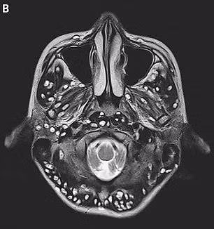 Ấu trùng sán lợn làm tổ dày đặc trong não, thanh niên 18 tuổi thiệt mạng sau 2 tuần ảnh 1 au trung san lon lam to day dac trong nao, thanh nien 18 tuoi thiet mang sau 2 tuan - 2