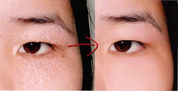 Mụn thịt tuổi dậy thì dày chạt như cơm cháy cũng xẹp lép với công thức chưa đến 10 ngàn đồng