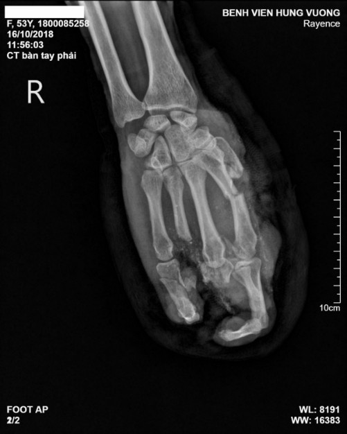 Phim chụp Xquang bàn tay của bệnh nhân. Ảnh: L.Q