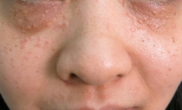 Mụn thịt tuổi dậy thì dày chạt như cơm cháy cũng xẹp lép với công thức chưa đến 10 ngàn đồng