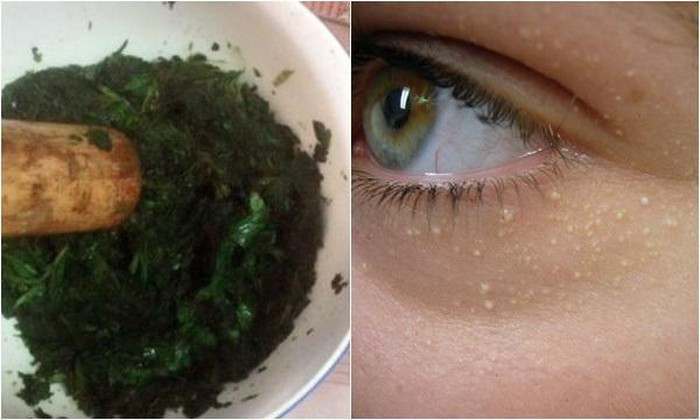 Mụn thịt tuổi dậy thì dày chạt như cơm cháy cũng xẹp lép với công thức chưa đến 10 ngàn đồng