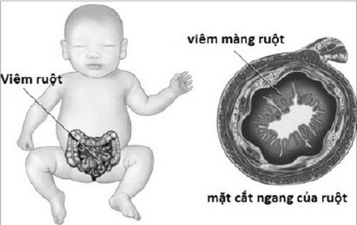 Cải thiện hội chứng kém hấp thu