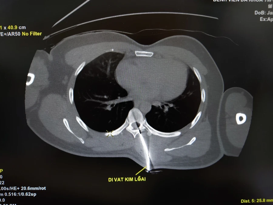 Hình dị vật kim loại trên phim CT ngực.