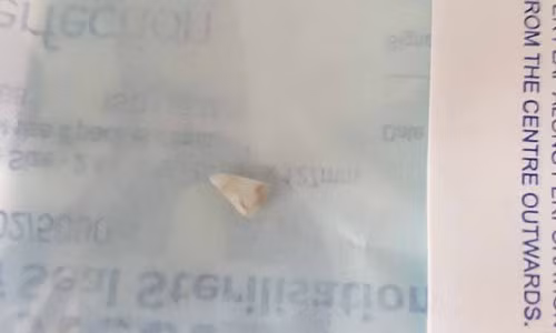 Chiếc răng nanh như Dracula trong miệng em bé 11 tuần tuổi - Hình 2