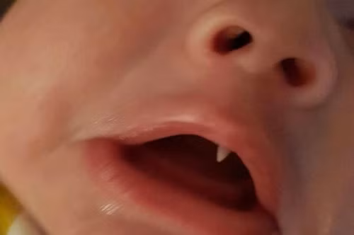 Chiếc răng nanh như Dracula trong miệng em bé 11 tuần tuổi - Hình 1