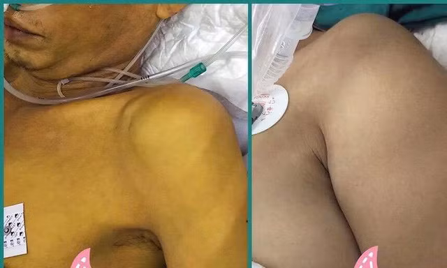  Hình ảnh bệnh nhân vàng như nghệ do rượu và bệnh nhân bình thường 