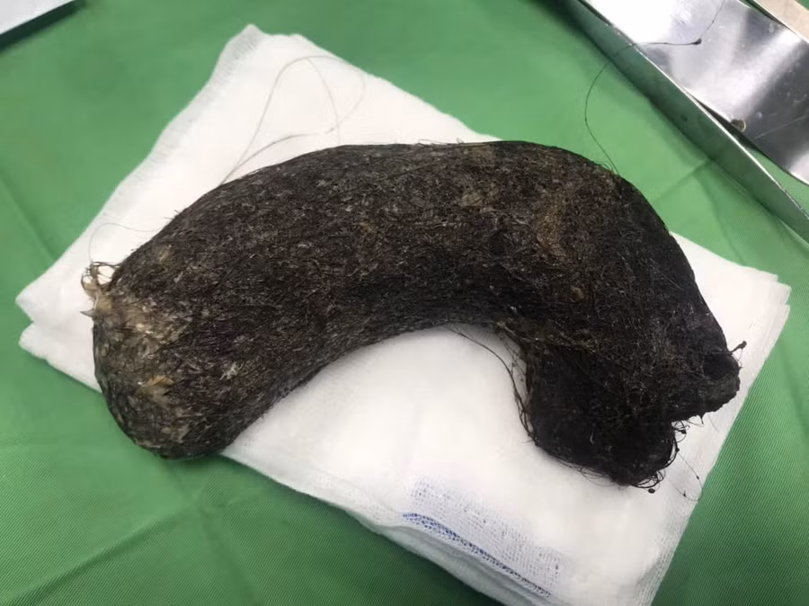 Búi tóc được lấy ra khỏi dạ dày bệnh nhi. Ảnh bệnh viện cung cấp.