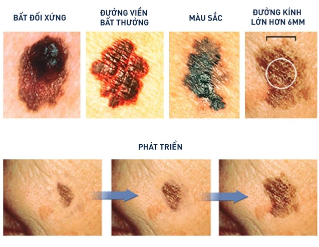 Chuyên gia hướng dẫn cách kiểm tra nốt ruồi trên cơ thể có khả năng gây ung thư hay không