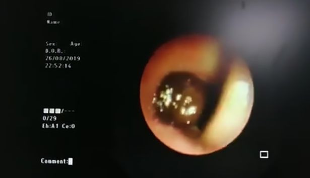 Con đỉa thò thụt trong họng cậu bé. Bé trai ho ra máu vì đỉa thò thụt trong khí quản