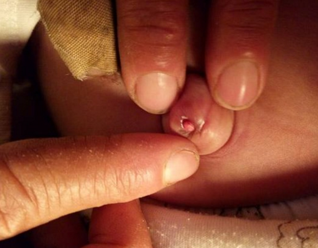 8 ngày sau sinh, bác sĩ nhìn thấy điều kinh khủng ở rốn em bé và tức giận vì sự thiếu hiểu biết của mẹ - Ảnh 4. 8 ngày sau sinh, bác sĩ nhìn thấy điều kinh khủng ở rốn em bé và tức giận vì sự thiếu hiểu biết của mẹ - Ảnh 4.