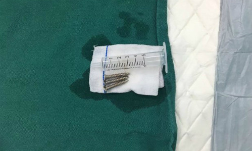 3 cái đinh được lấy ra khỏi dạ dày em bé sơ sinh - Ảnh: Asia Wire