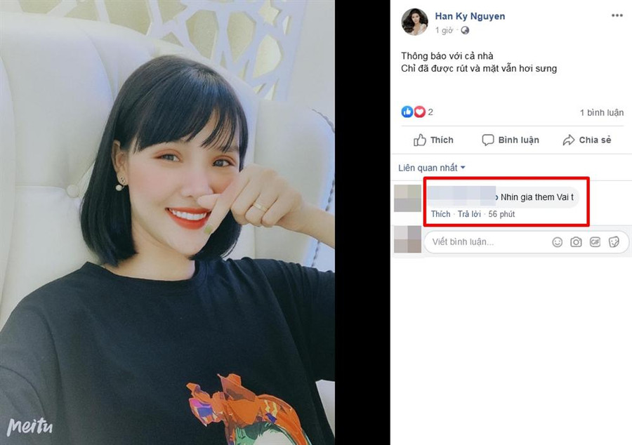 Gương mặt Kỳ Hân bị chê "đơ như cây cơ" sau thẩm mỹ ảnh 6 Tưởng cắt chỉ thẩm mỹ xong sẽ xinh đẹp hơn, ai dè gương mặt Kỳ Hân lại bị chê đơ như cây cơ-6