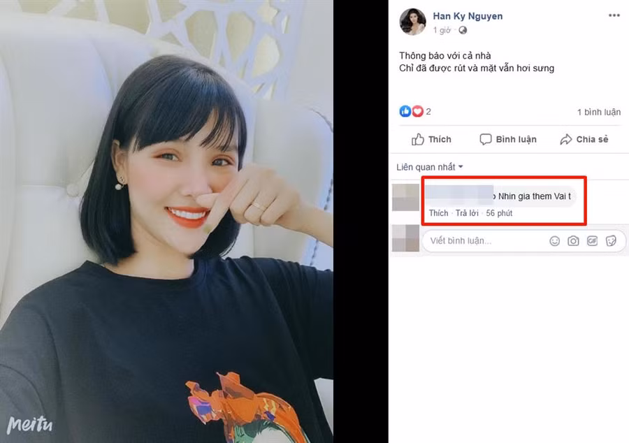 Tưởng cắt chỉ thẩm mỹ xong sẽ xinh đẹp hơn, ai dè gương mặt Kỳ Hân lại bị chê đơ như cây cơ-6