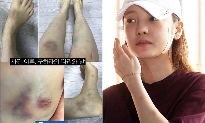 Những minh tinh Hàn Quốc từng bị chồng đánh đến mức phải nhập viện