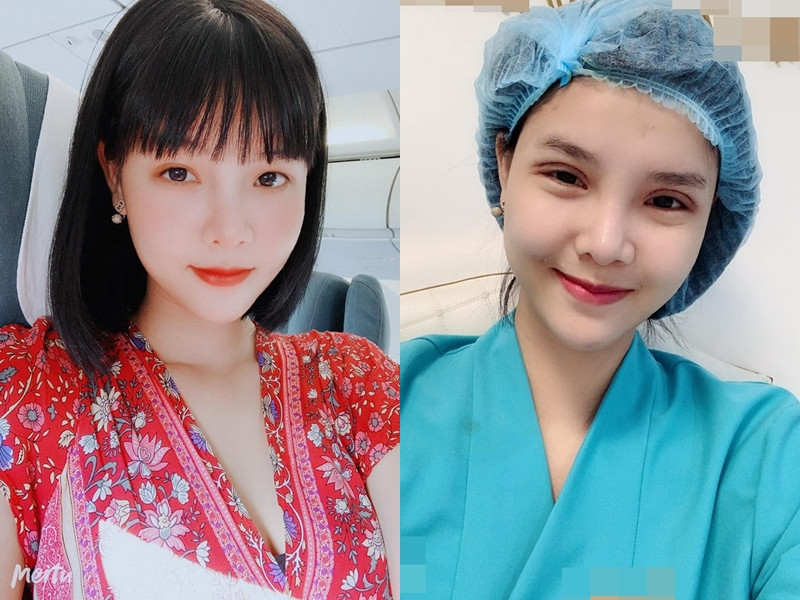 Gương mặt Kỳ Hân bị chê "đơ như cây cơ" sau thẩm mỹ ảnh 3 Tưởng cắt chỉ thẩm mỹ xong sẽ xinh đẹp hơn, ai dè gương mặt Kỳ Hân lại bị chê đơ như cây cơ-3