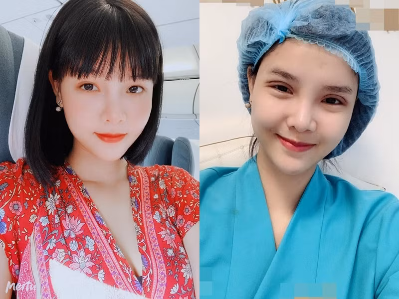 Tưởng cắt chỉ thẩm mỹ xong sẽ xinh đẹp hơn, ai dè gương mặt Kỳ Hân lại bị chê đơ như cây cơ-3