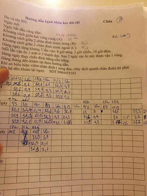 Hướng dẫn kéo chân và chi tiết quá trình tăng chiều cao của Tùng Anh. chang-trai-ha-thanh-ton-gan-100-trieu-dong-phau-thuat-keo-chan-tu-1m67-len-1m76-1