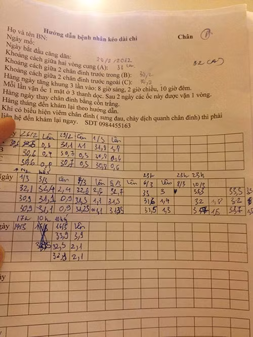chang-trai-ha-thanh-ton-gan-100-trieu-dong-phau-thuat-keo-chan-tu-1m67-len-1m76-1