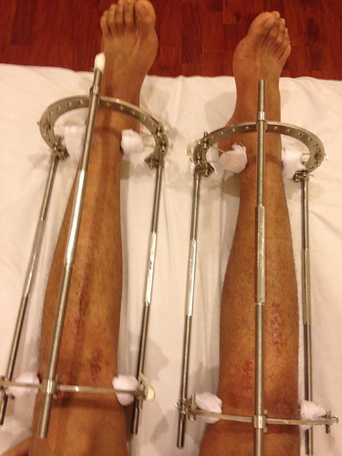 Chàng trai Hà thành cho biết sẹo để lại có thể xóa bỏ. chang-trai-ha-thanh-ton-gan-100-trieu-dong-phau-thuat-keo-chan-tu-1m67-len-1m76-2