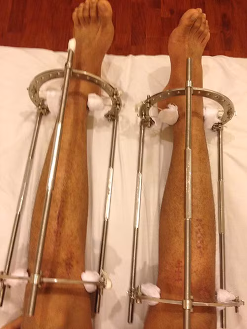 chang-trai-ha-thanh-ton-gan-100-trieu-dong-phau-thuat-keo-chan-tu-1m67-len-1m76-2