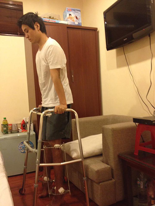 Tùng Anh trong quá trình tập đi và phục hồi sau phẫu thuật. chang-trai-ha-thanh-ton-gan-100-trieu-dong-phau-thuat-keo-chan-tu-1m67-len-1m76