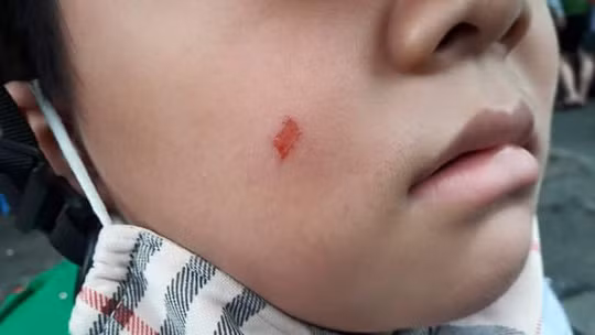 Vết xước trên mặt em Hoàng.G khiến bà Cúc lao đến trường tát vào mặt cô giáo