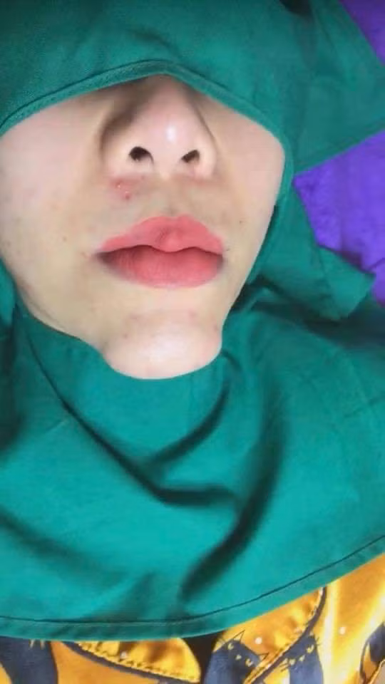 Cằm biến thành U-line sau PTTM, hình ảnh khiến nhiều người giật mình kinh hãi-3