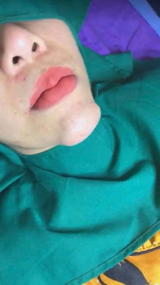 Cằm biến thành U-line sau PTTM, hình ảnh khiến nhiều người giật mình kinh hãi-1