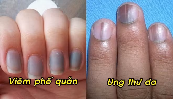 Móng tay có dấu hiệu này phải đi khám ngay đề phòng bệnh nguy hiểm 